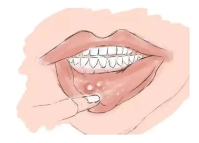 六个小方法快速治愈口腔溃疡 出现了口腔溃疡要怎么办呢？