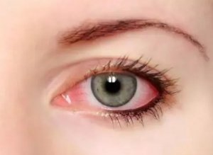 红眼病是怎么传染的 游泳时护眼需注意什么