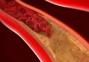 血管发出的求救信号有哪些 怎么预防血管堵塞