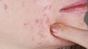 引起湿疹的原因是什么 皮炎和湿疹的区别有什么