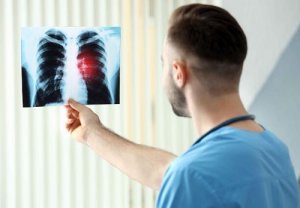 肺癌的早期症状和前兆是什么 肺癌一般是几年形成的