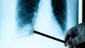 晚期肺癌治疗有什么 治疗晚期肺癌的方法