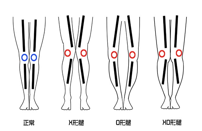 腿型