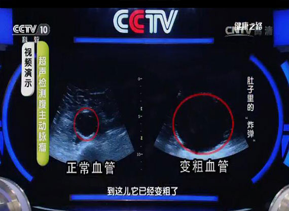 超声检查腹主动脉瘤