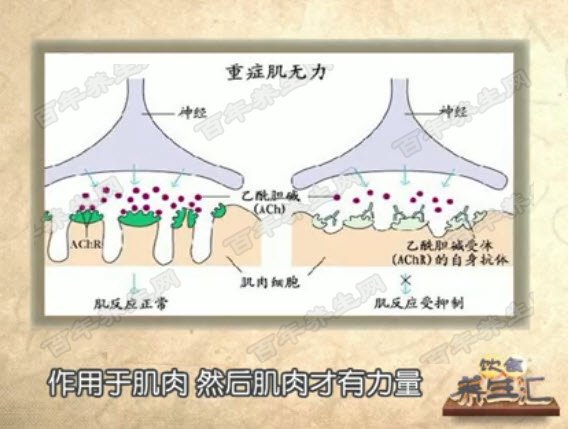 重症肌无力