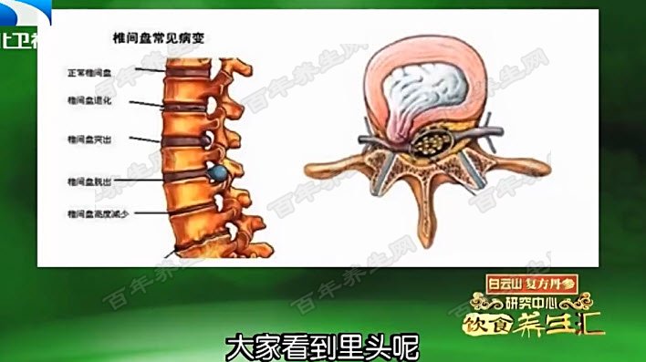 腰椎间盘突出