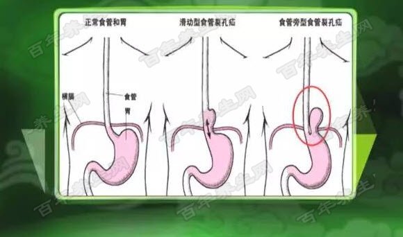 食管裂孔疝