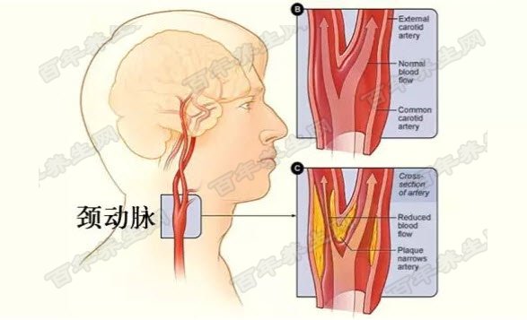 颈动脉斑块