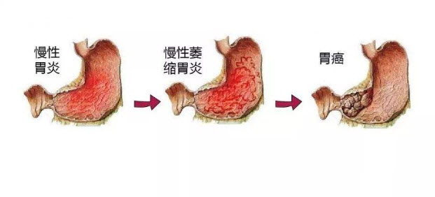 莫把炎症变癌症