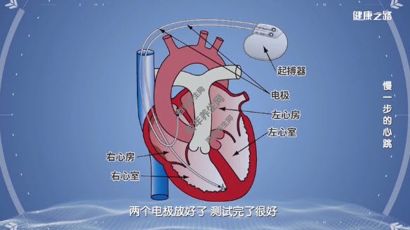 慢一步的心跳