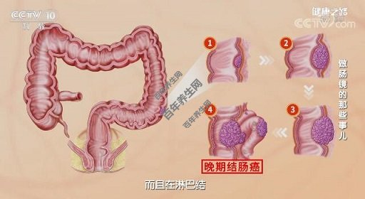 晚期结肠癌