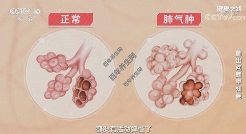 正常肺泡VS肺气肿肺泡