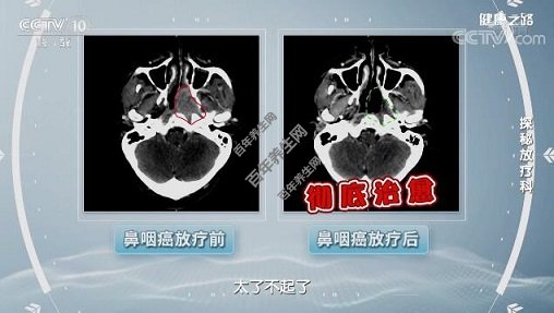 鼻咽癌放疗前VS放疗后