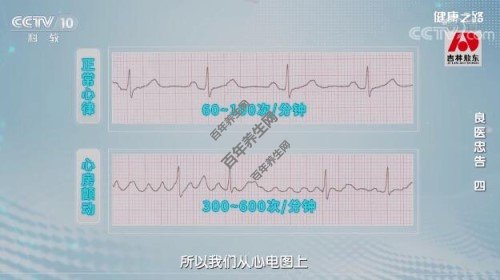 正常心律VS心房颤动