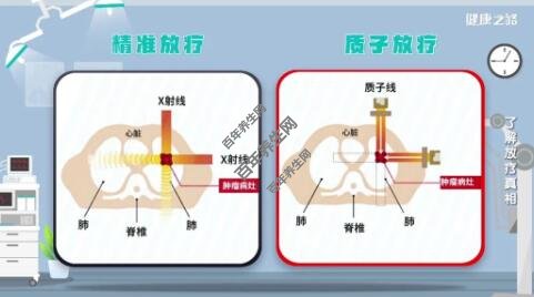 精准放疗