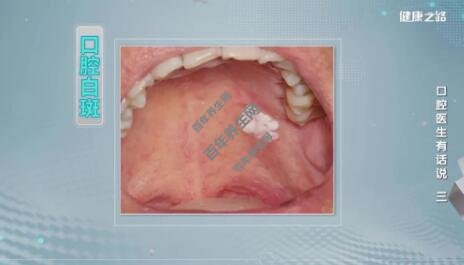 口腔白斑