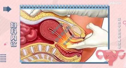 妇科内诊
