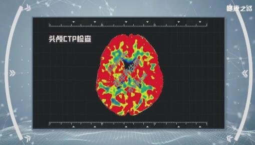 头颅CTP检查