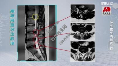 腰椎间盘突出影像