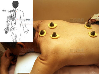 巧用艾灸祛病 常灸三穴位健康无忧