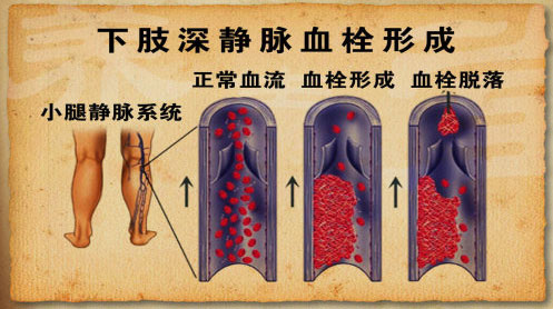 下肢深静脉血栓形成