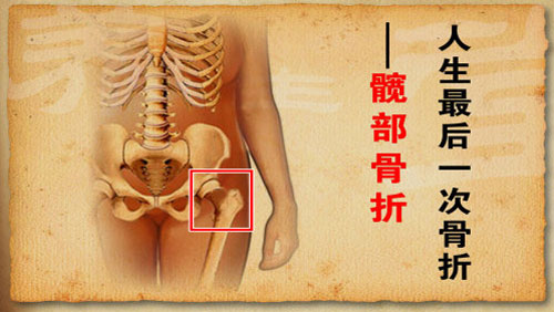 髋部骨折称为“人生最后一次骨折”
