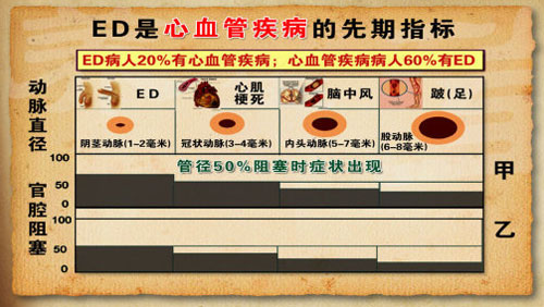 ED是心血管疾病的先期指标