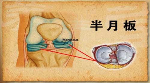 中老年人群多发膝关节弹响，并在很大程度上与半月板的退化和损伤有关