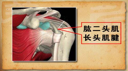 肱二头肌长头肌腱炎占肩关节疼痛的30%－40%