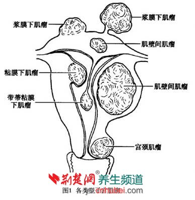 子宫肌瘤的分类