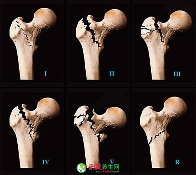 股骨头坏死的手术治疗方法