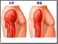 股骨头坏死患者疼痛的治疗方法