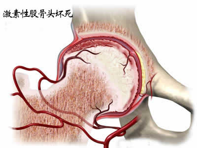 临床上股骨头坏死的检查方法都有哪些