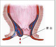 大便出血的原因及检查方法