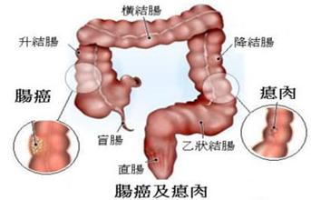 肠癌的早期症状是不是大便出血