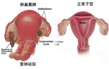 恶性卵巢囊肿会有哪些危害