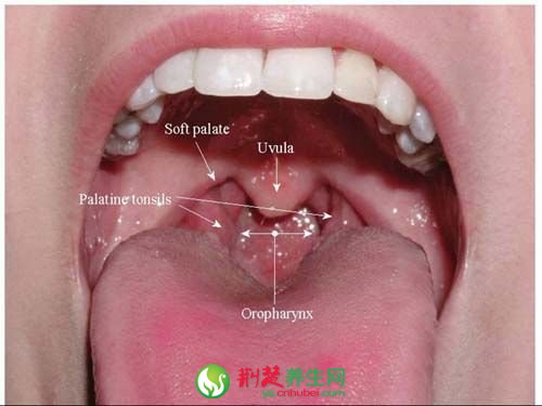 喉炎的病理分类与治疗方法