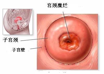 宫颈糜烂的正确护理及注意事项