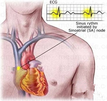 心脏早搏是怎么回事 哪些因素引起心脏早搏