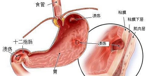 胃溃疡的饮食误区有哪些