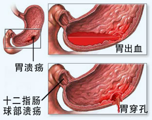 胃溃疡的病因和护理方法都有哪些