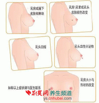 谨防乳腺癌 症状大对比