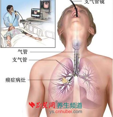 肺癌的早期症状