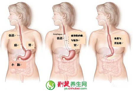 易患食道癌的潜在人群