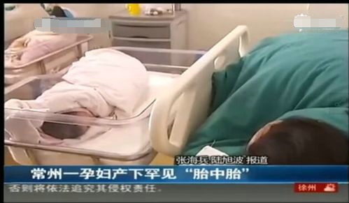 婴儿也会怀孕 孕妇产下胎中胎