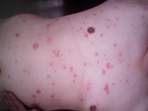 夏季易蚊虫叮咬  专家提醒谨防带来丘疹状荨麻疹
