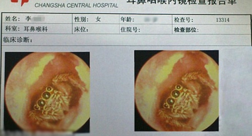 美少年耳中长蜈蚣 盘点虫子钻耳朵事件