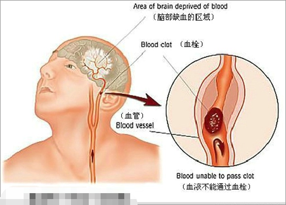 脑血栓的治疗方法 按摩穴位有助于康复