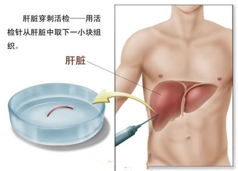 转氨酶高是怎么回事 转氨酶偏高应对方法