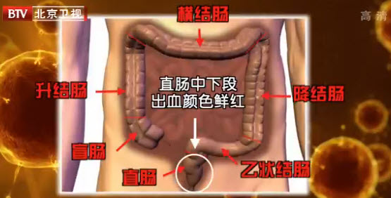 结直肠癌